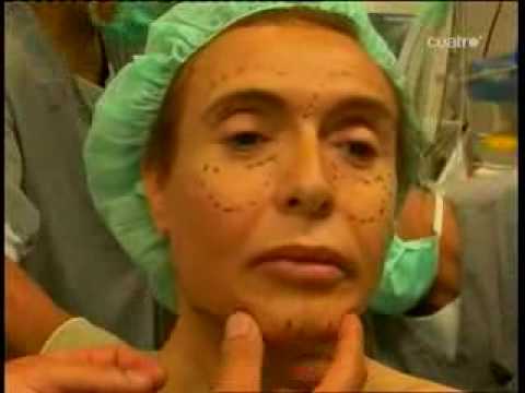 Feminización Facial 1