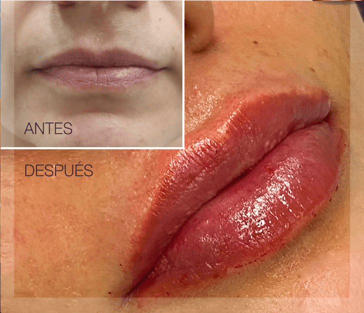 aumento de labios-1
