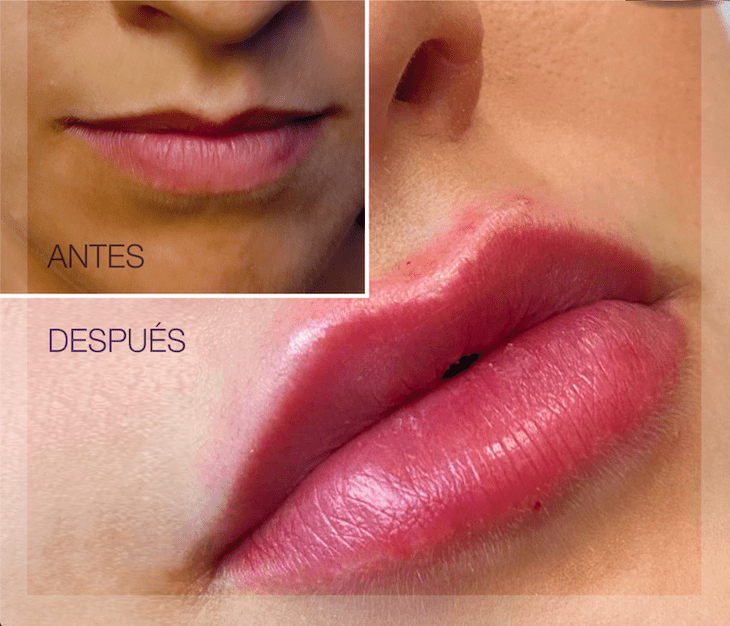 aumento de labios-2