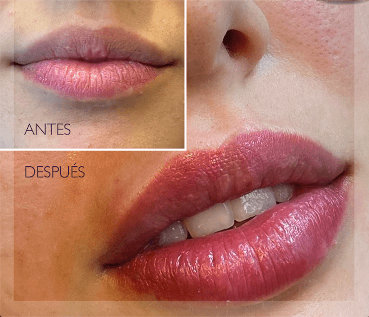 aumento de labios-3