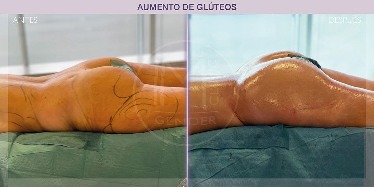 AD gluteos IM GENDER-12 aumento de glúteos