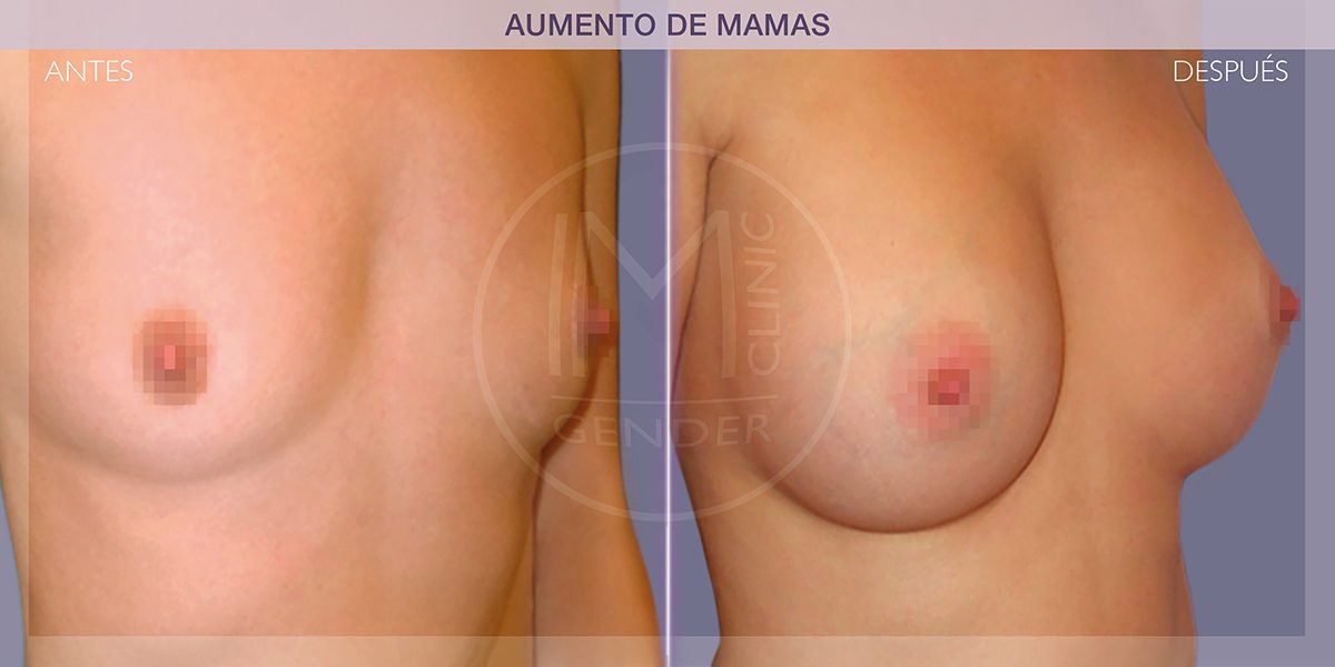 AUMENTO7