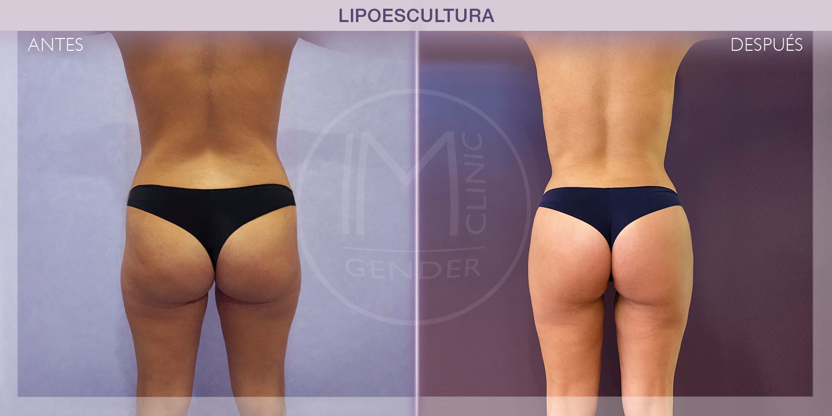 AD LIPO IM GENDER3 Antes y después de una lipoescultura