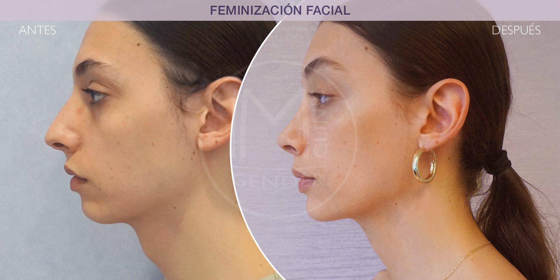 resultado de la feminización facial antes y despés de la feminizaci