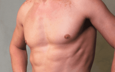 Top surgery in trans men: The most requested procedure