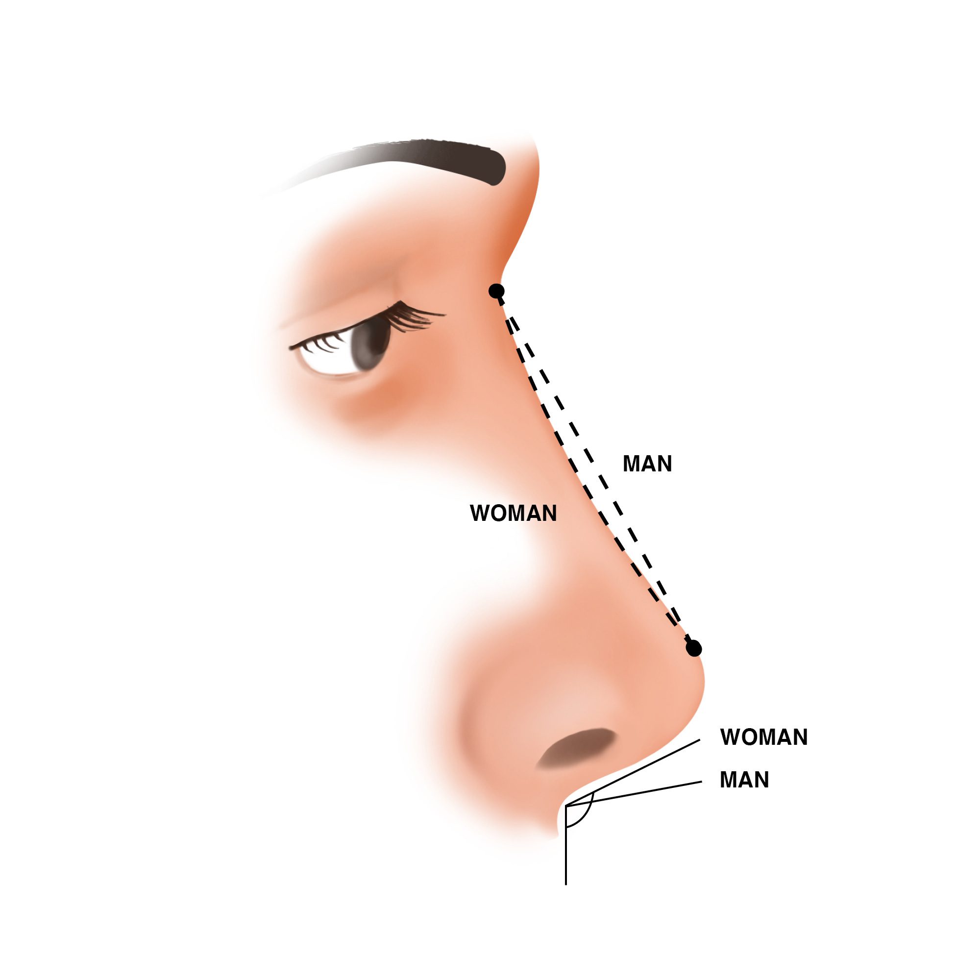 mtf-feminizing-rhinoplasty-imgender Ilustración sobre las diferencias entre la nariz masculina y la nariz femenina