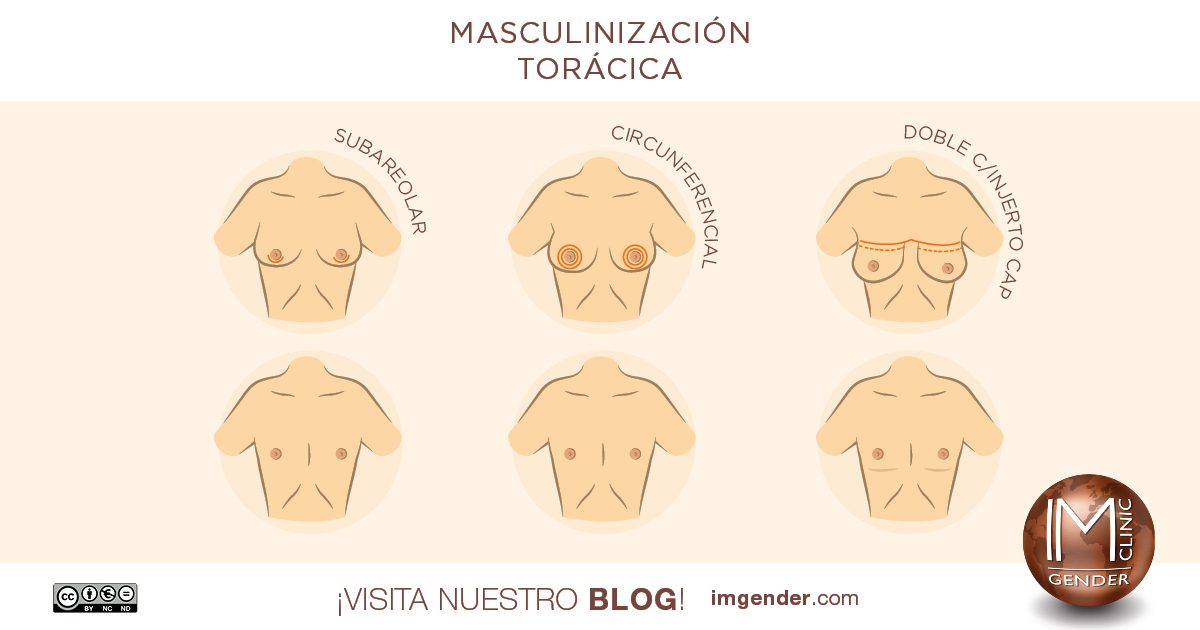 INFOGRAFIA-MASCULINIZACION-TORACICA-IMGENDER Infografica mastectomía trans